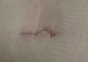SILS Magnified Scar