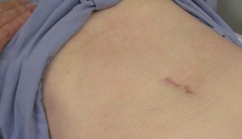 SILS scar