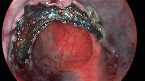 polyp removed wound exposed