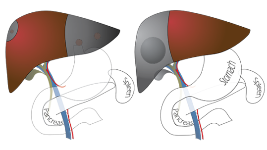 R hepatectomy hepatic resection