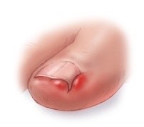ingrown toe nail